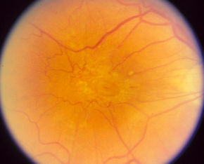 Epiretinal membrane Epiretinal membrane